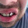 Silver op & Bottom Grills for Teeth Harlembling