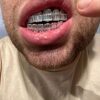Harlembling Solid 925 Sterling Silver Real Baguette Grillz