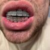 Harlembling Solid 925 Sterling Silver Real Baguette Grillz